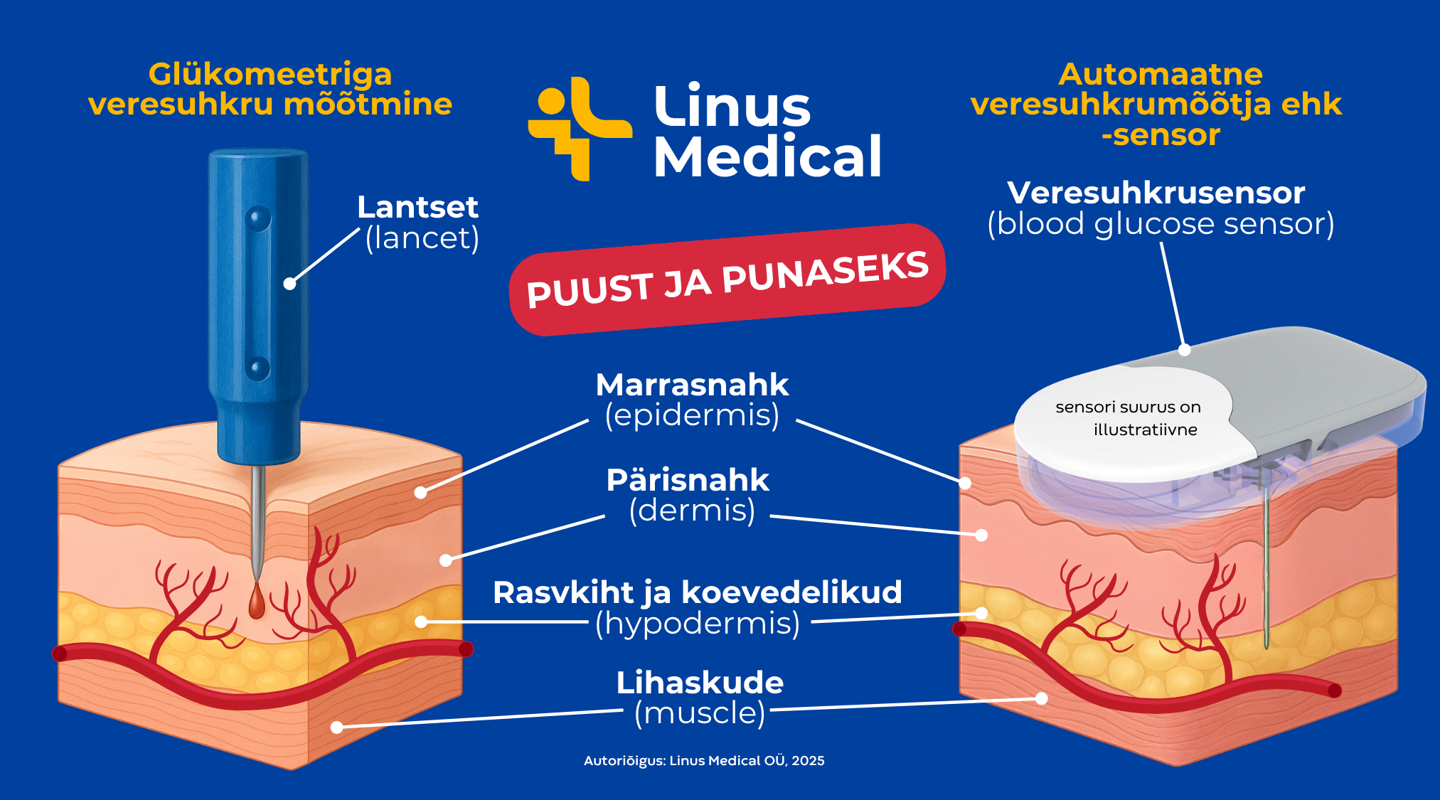 lantset vs sensor